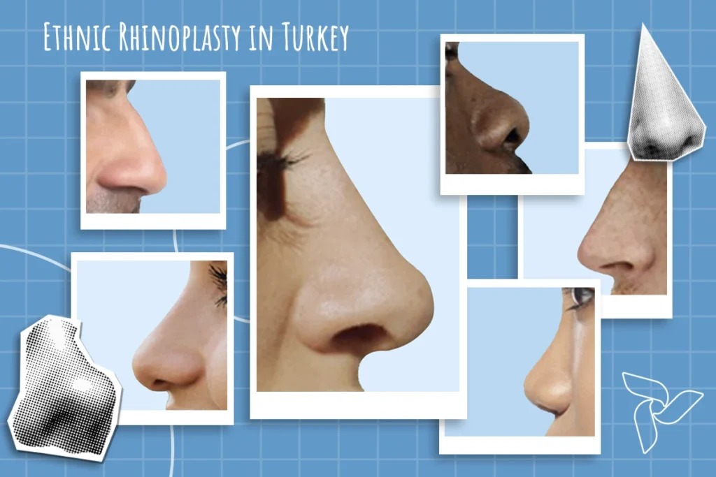 ethnic rhinoplasty in turkey with arpanu aesthetics