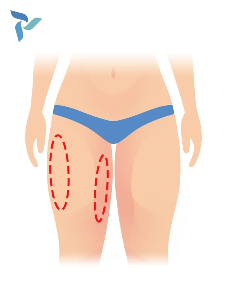 Full Thigh Lift (Extended Medial Thigh Lift)