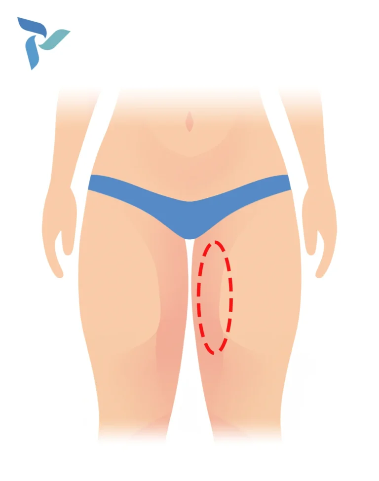 Inner Thigh Lift (Medial Thigh Lift)