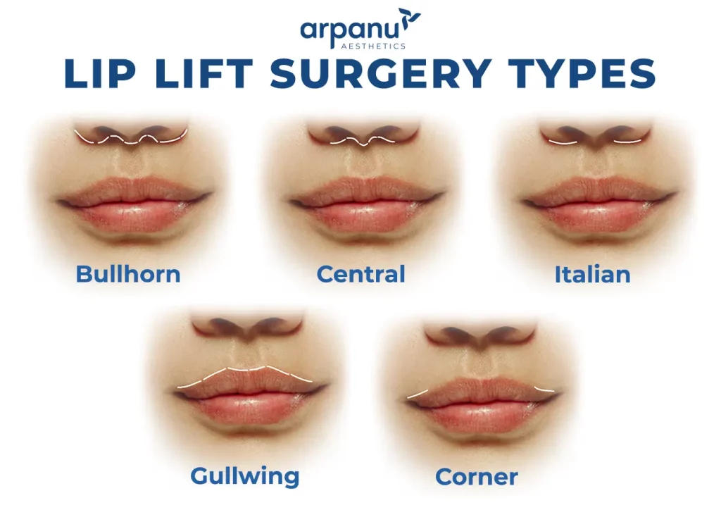 different surgical incisions are shown for lip lift procedure