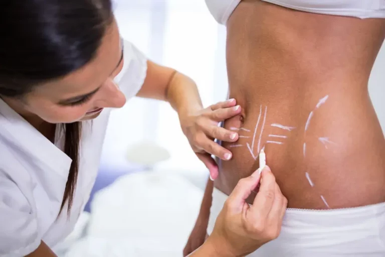 a woman getting surgery markings before a liposuction in turkey