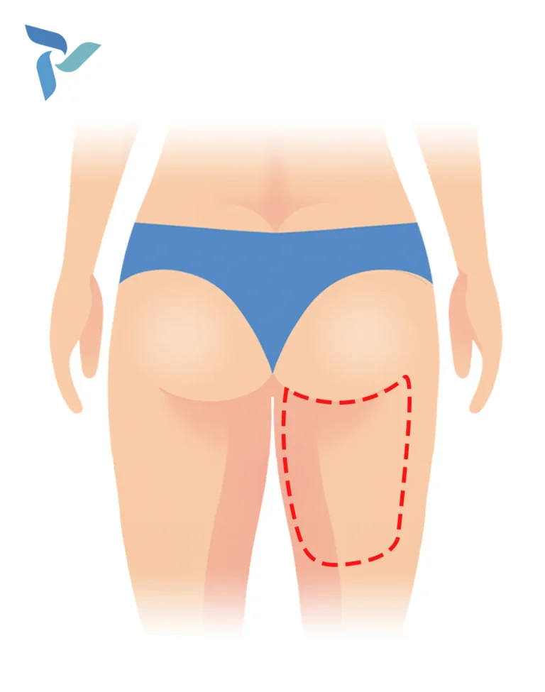 Posterior Lift