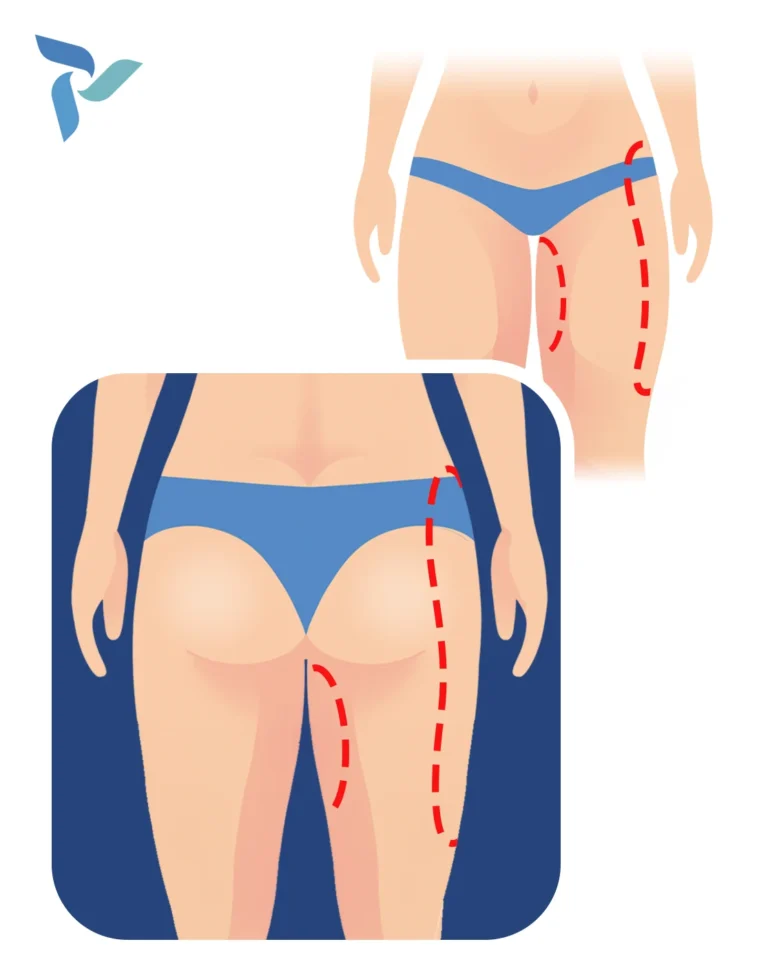 Spiral Thigh Lift