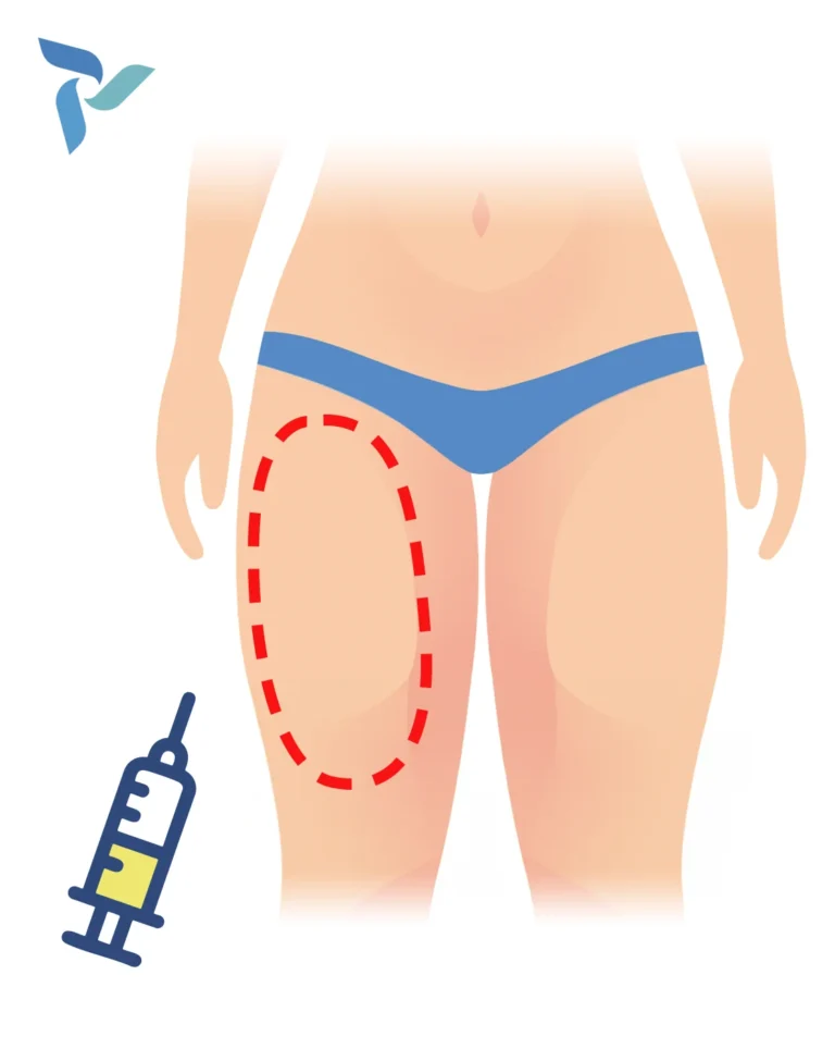 Thigh Lift with Liposuction