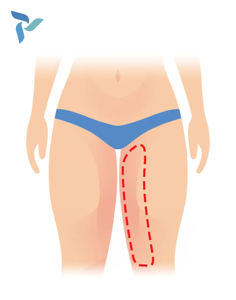 Vertical Thigh Lift
