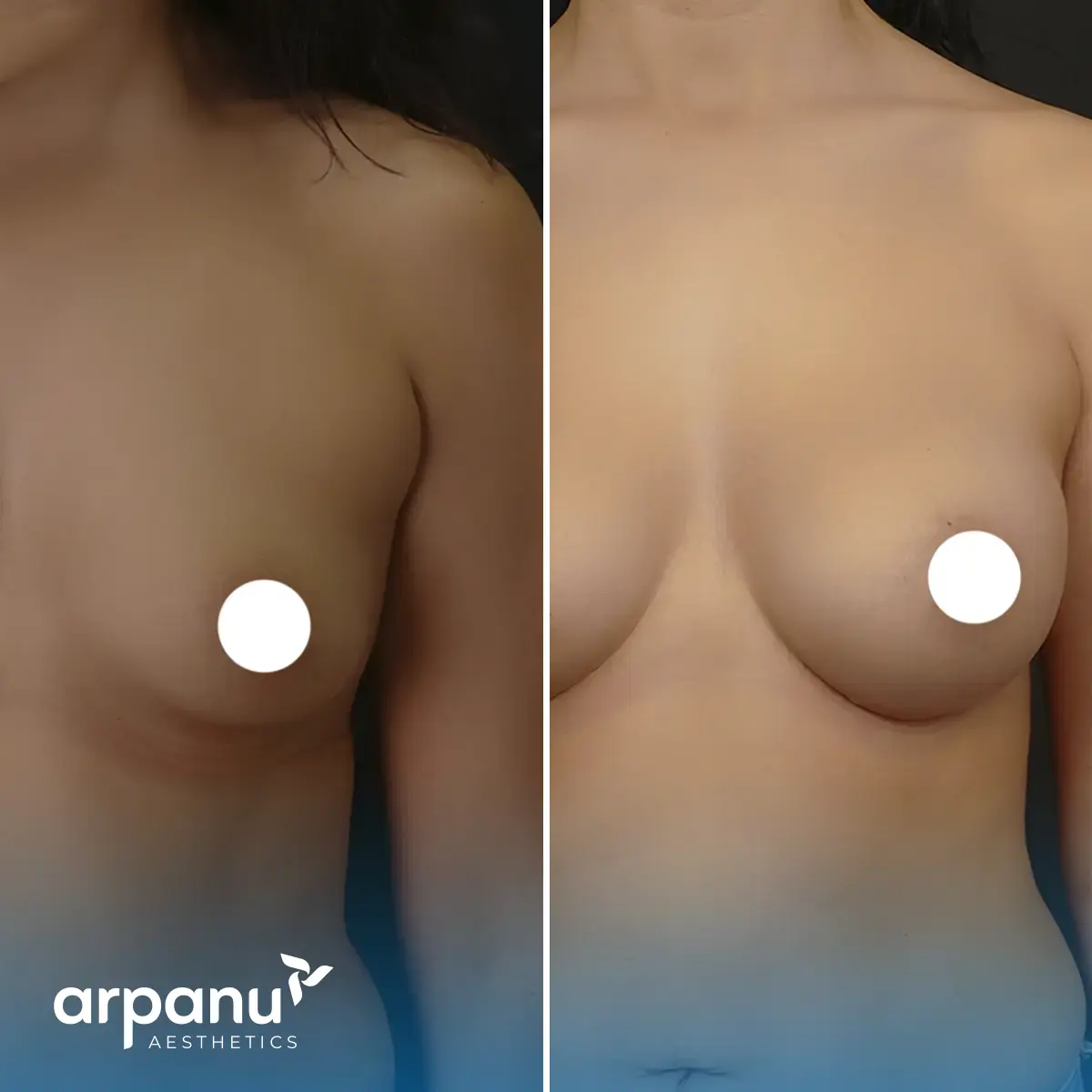 breast augmentation before after in turkey