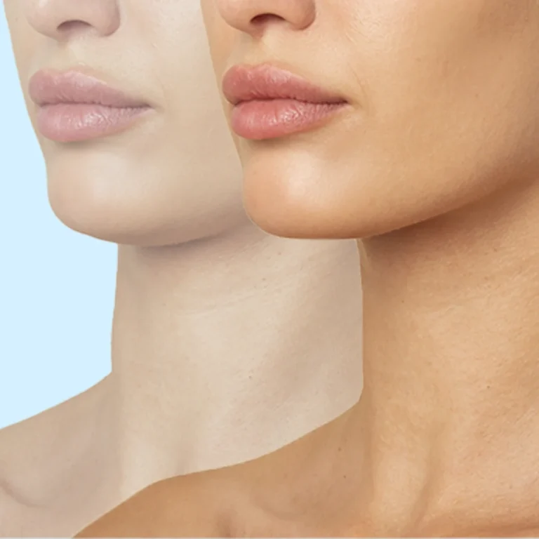 Chin Implant surgery turkey