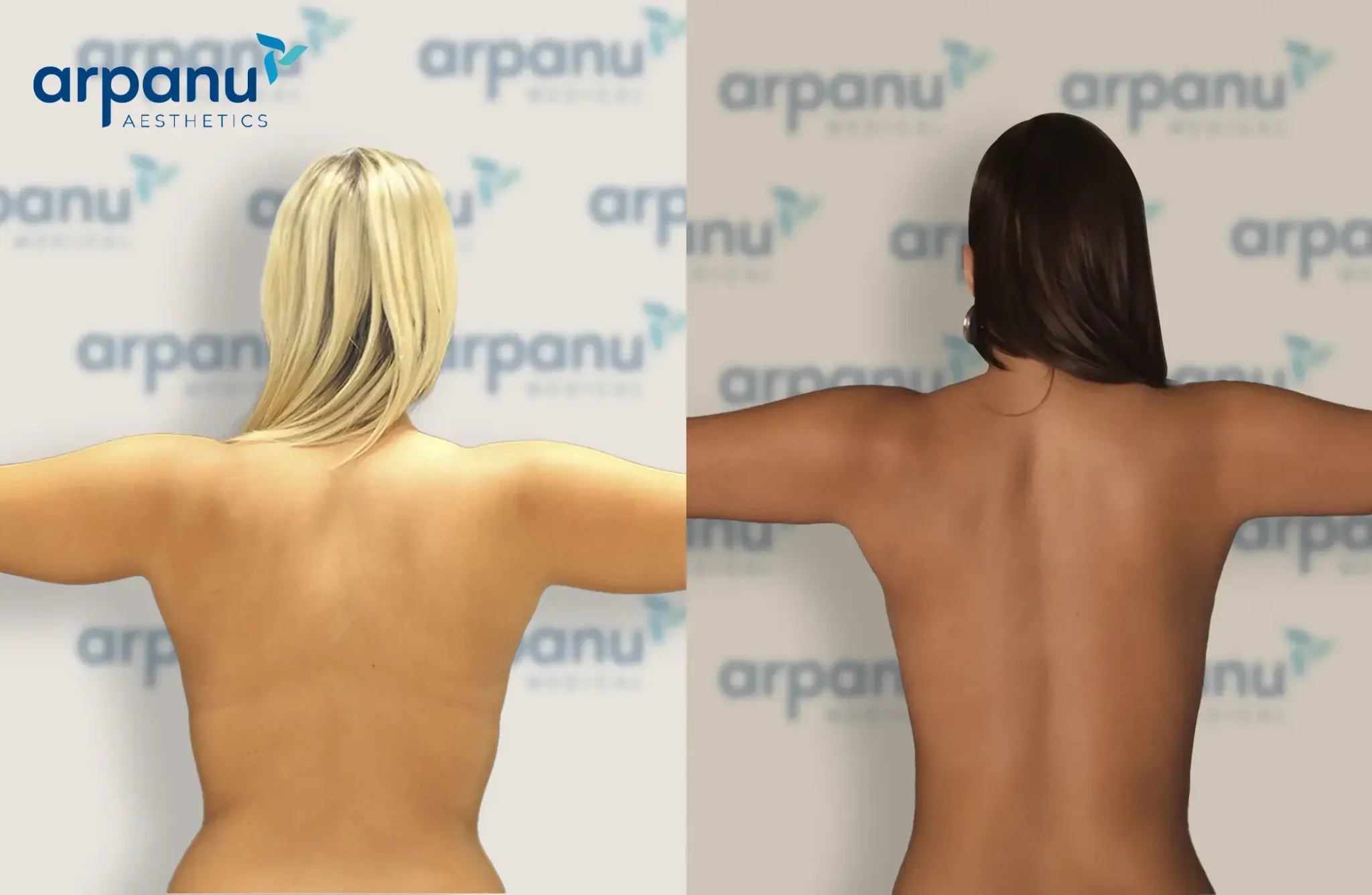 liposuction surgery in turkey before after