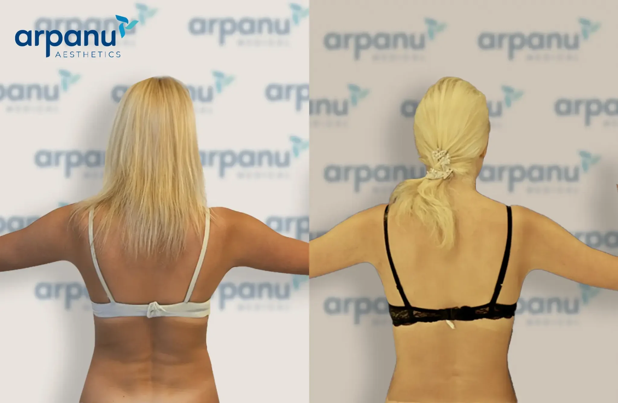 liposuction surgery in turkey before after