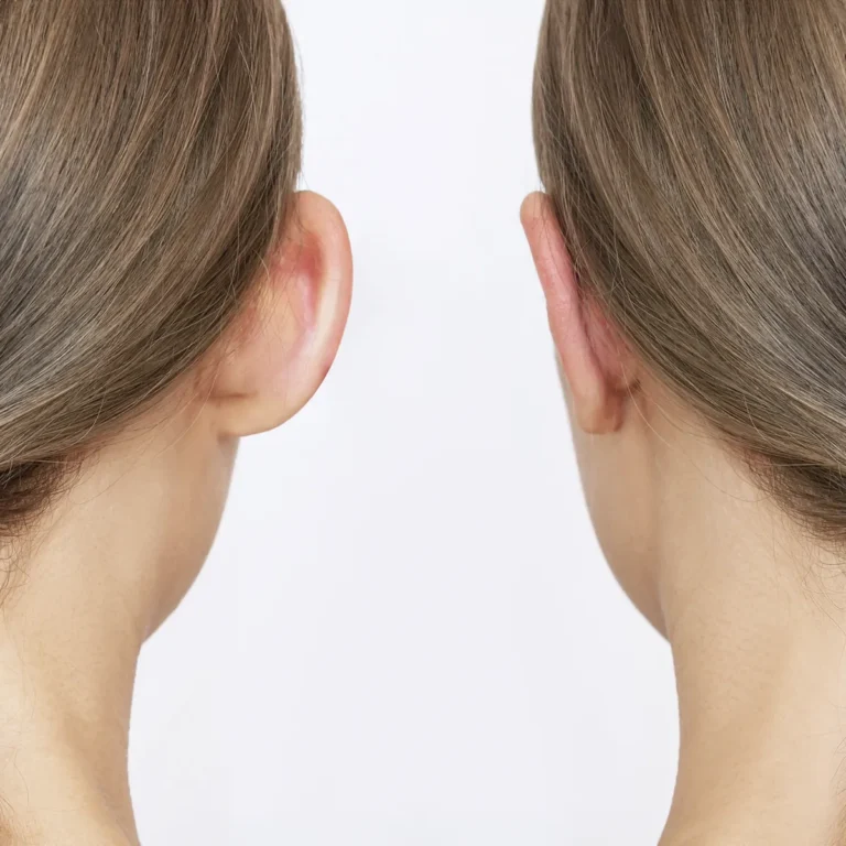 otoplasty-turkey-3