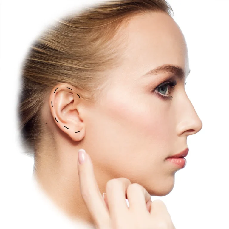 otoplasty-surgery